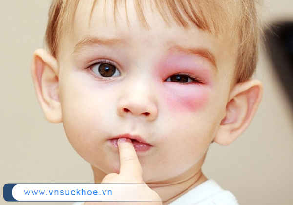 Đau mắt đỏ là bệnh nhi khoa thường gặp ở trẻ em mà các bậc cha mẹ nên lưu ý