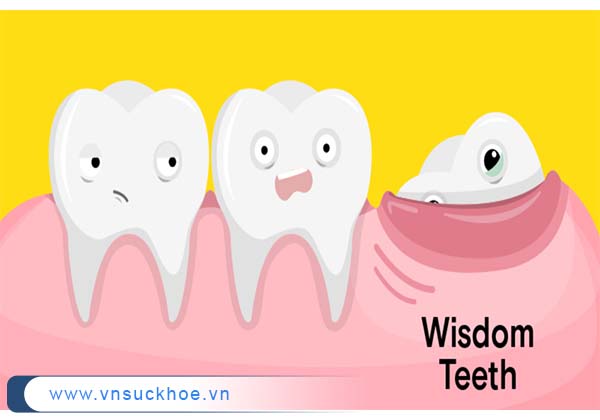 Răng khôn nổi lên một phần qua nướu răng
