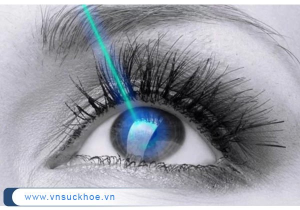 Mổ mắt cận thị là gì?