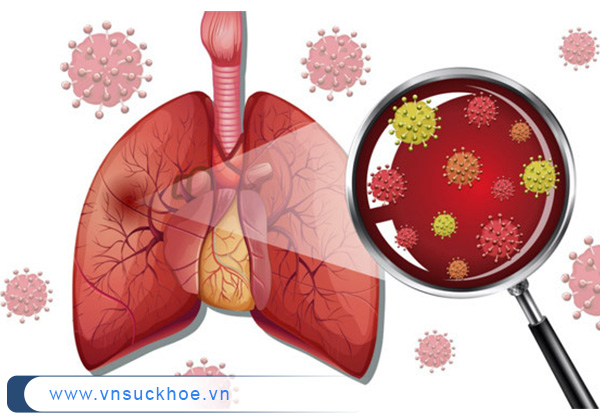 Nguyên nhân gây viêm phổi