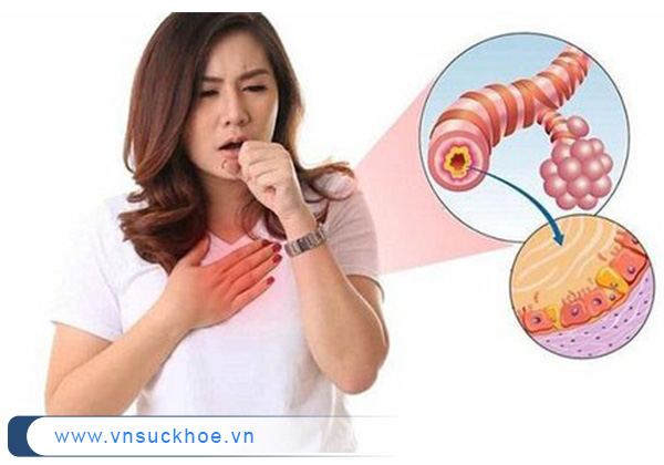 Triệu chứng đặc trưng của viêm phổi