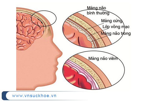 Trẻ có thể bị viêm màng não nếu mắc thủy đậu