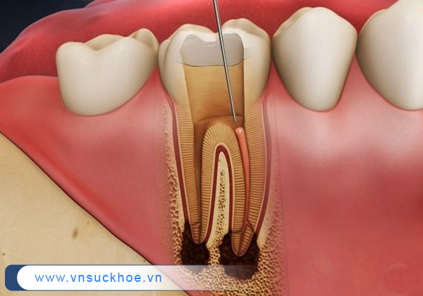 Tình trạng hoại tử tủy răng cần được phát hiện và điều trị sớm