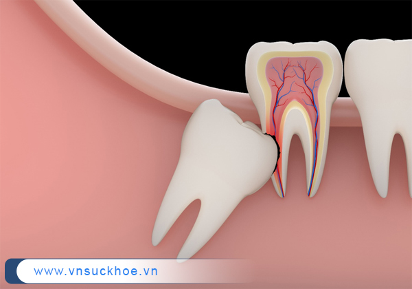 Răng khôn mọc lệch có thể khiến người bệnh đối mặt với nhiều biến chứng nguy hiểm