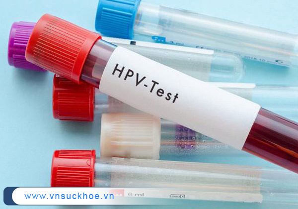 Bạn cần biết: Xét nghiệm HPV cần chuẩn bị những gì?
